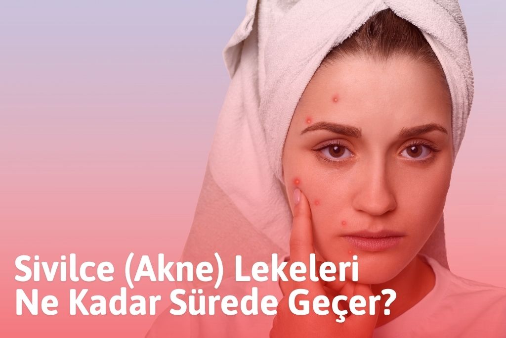 Sivilce (Akne) Lekeleri Ne Kadar Sürede Geçer?
